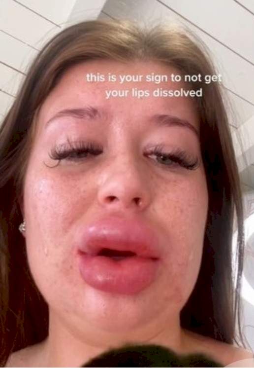 'This is your sign to not get your lips dissolved' - Lady warns as severe reaction to filler dissolvent causes her lips to balloon