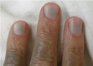 Here's what your fingernails reveal about the state of your health