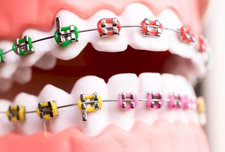 Things To Know Before Choosing Braces
