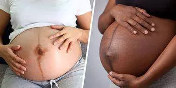 Here's what causes the black line on a pregnant woman's stomach