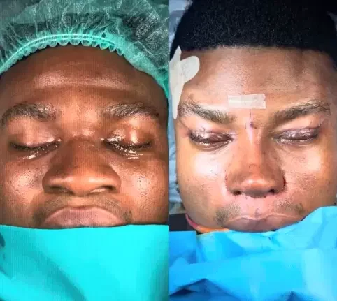 Zicsaloma nose surgery