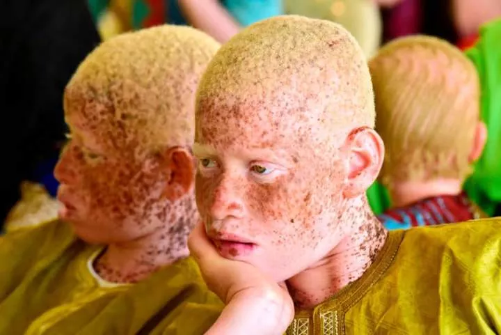 7 common myths about people living with albinism