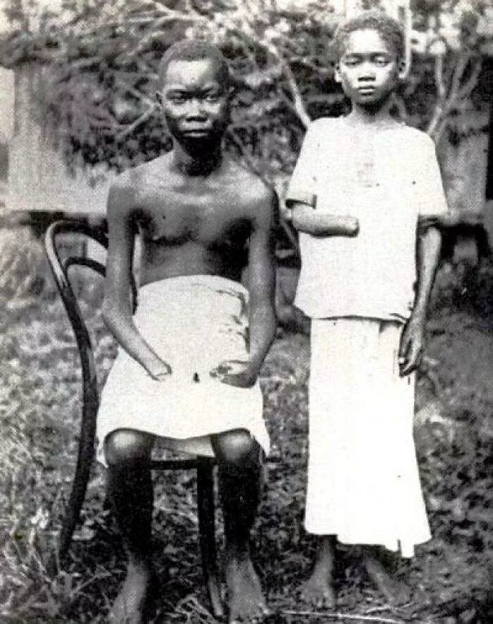 In The 1890s, The Congo State (Controlled By Belgian Settlers) Allowed The Companies To Maneuver Almost Entirely Freely, Which Resulted In Various Atrocities, Including The Amputation Of Hands As Punishment For Those Who Refused To Collect Rubber