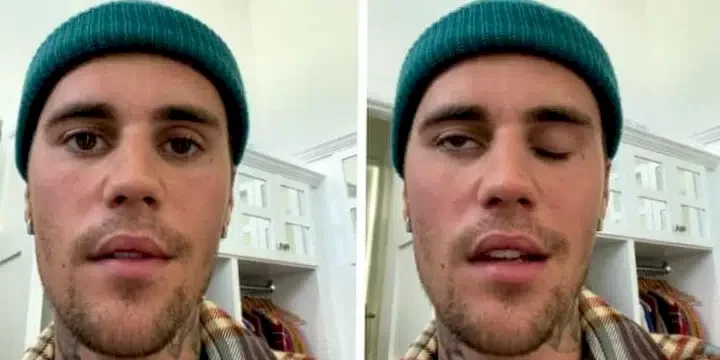 Justin Bieber reveals his face is half-paralyzed after being diagnosed with Ramsay Hunt Syndrome (Video)