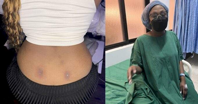 Lady ends up in the hospital after getting a dimple piercing on her back