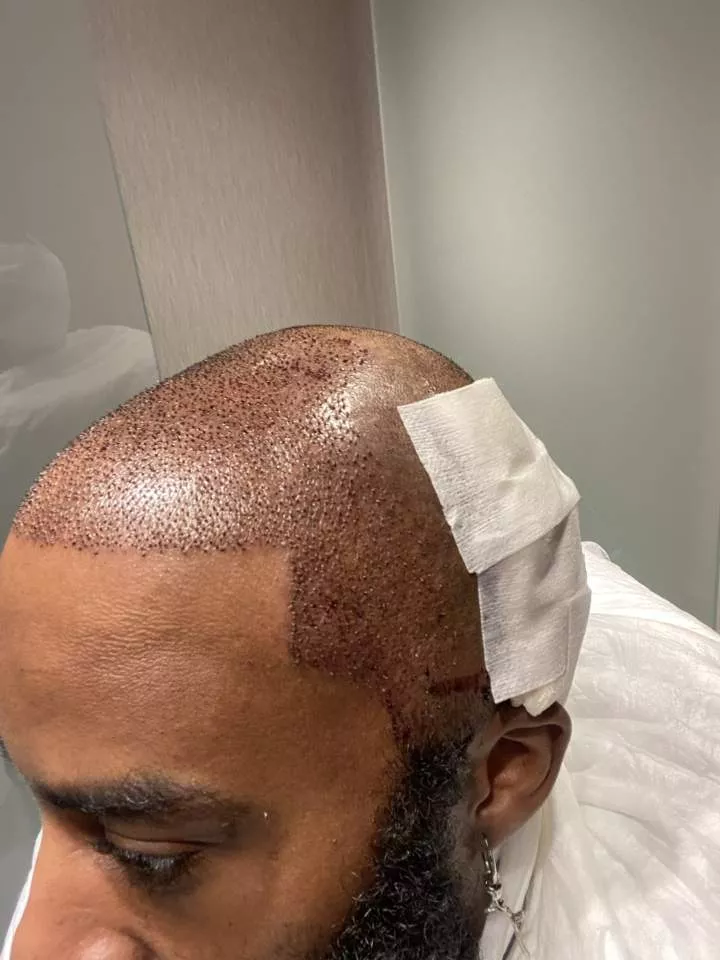 Bald man shows off amazing transformation after getting hair transplant surgery