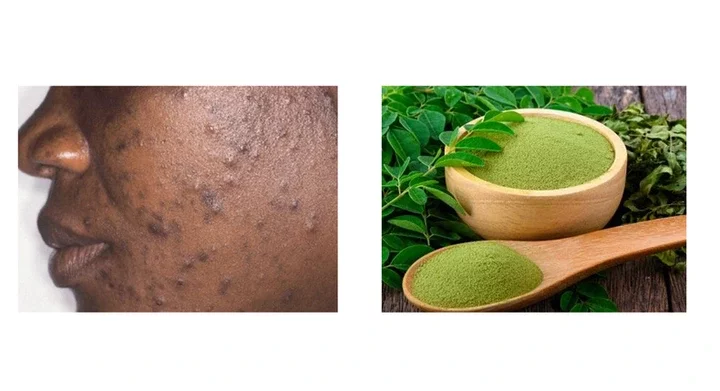 How moringa leaves can clear acne and pimples 