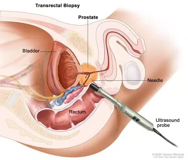 Saving Nigerian Men from Prostate Cancer Scourge
