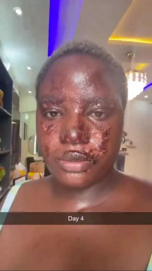 Beautiful lady narrates terrifying experience where a pressure pot nearly took her sight