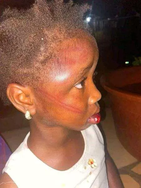 Starving 5-year-old girl mercilessly beaten by her aunt for taking food from pot to eat