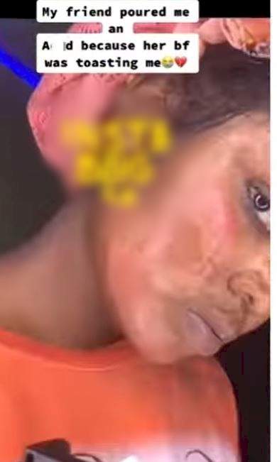 'My bestie bathed me with acid because her man was wooing me' - Lady claims (Video)
