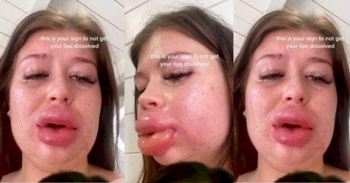"This is your sign to not get your lips dissolved" - Lady warns as severe reaction to filler dissolvent causes her lips to balloon