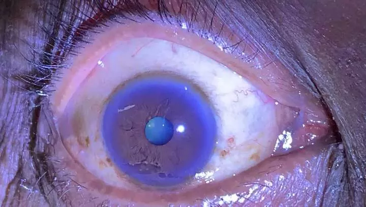 Crying blood and 5 other strange things that can happen to your eyes