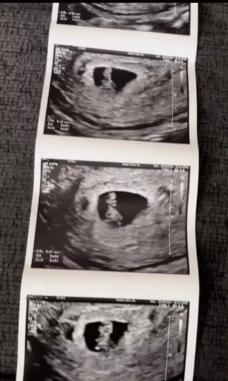 25-year-old man over the moon as he expects first child with his 63-year-old wife, shares ultrasound online