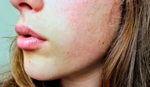 How To Remove Spots From Face In 2 Days Naturally