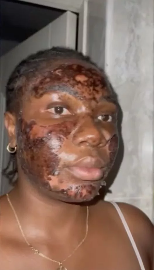 Lady cries out after severe burn from vendor's 'free' acne procedure