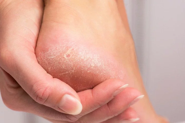 dry, dead skin on heel