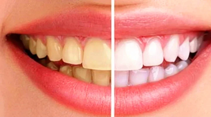 Natural Ways You Can Remove Yellow Stains From Your Teeth