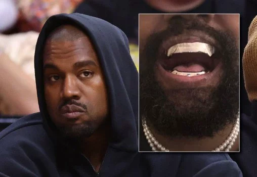Top dentist reveals the huge problem with Kanye West's new titanium teeth