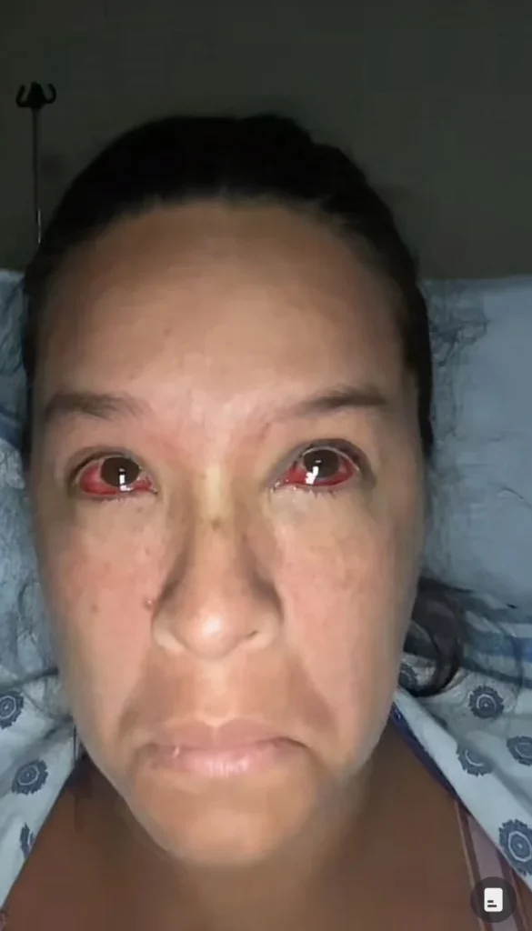 Woman shares how giving birth to her baby explodes blood vessels of her eyes