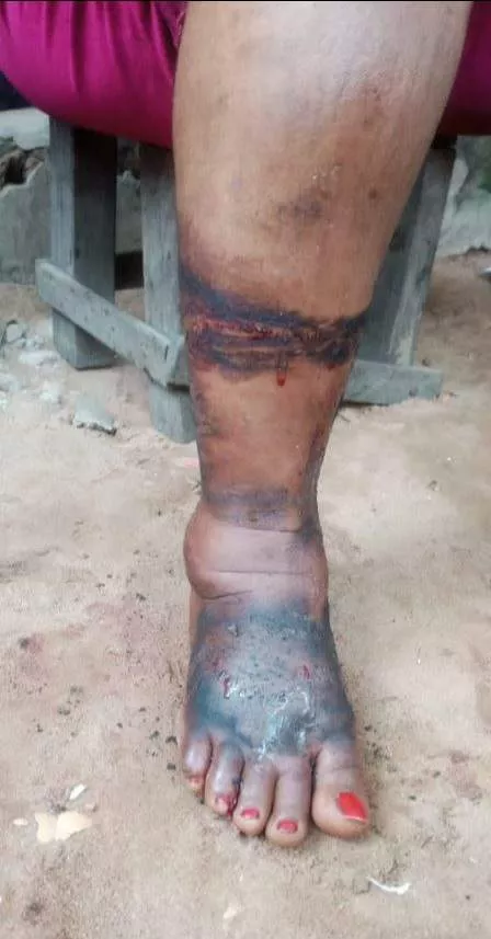 Nursing mother disfugured after she was allegedly brutalised by Special Anti Touting squad in Anambra