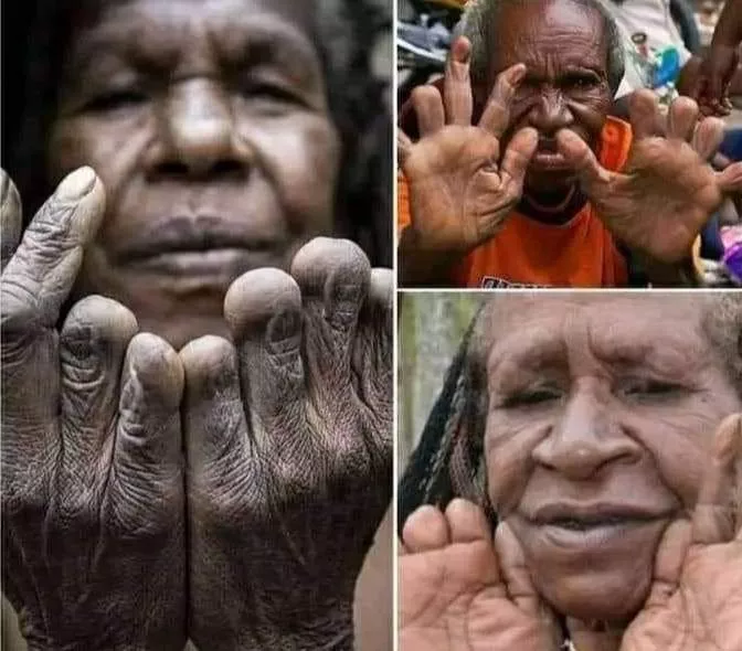 See the tribe where women cut off their fingers when a loved one dies