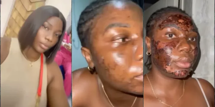 Lady cries out after severe burn from vendor's 'free' acne procedure