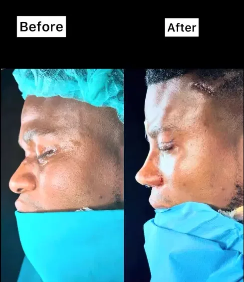 Zicsaloma nose surgery 2