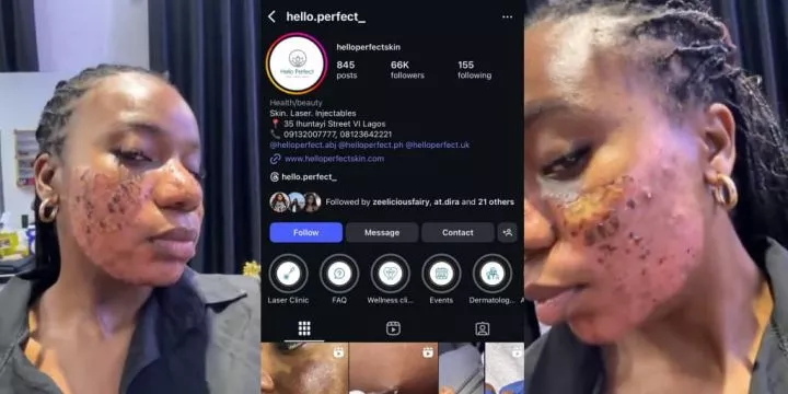 Clinic allegedly vows to jail lady for speaking out after acne treatment results in permanent scar Clinic allegedly vows to jail lady for speaking out after acne treatment results in permanent scar