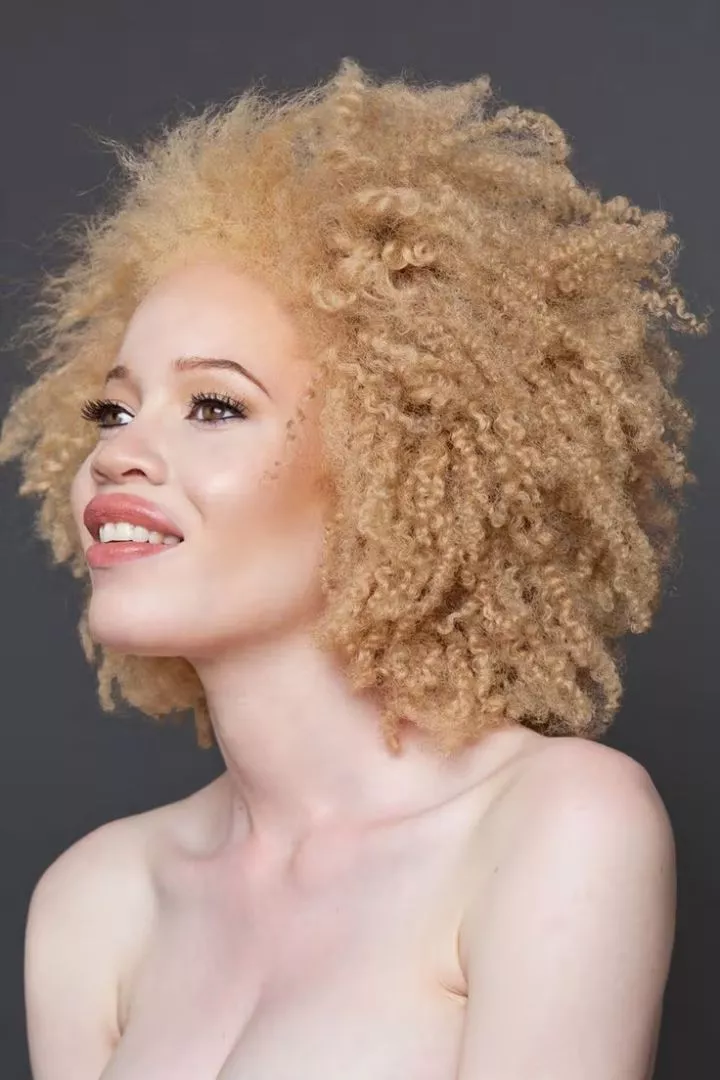 5 types of albinos and how they look (Photos)