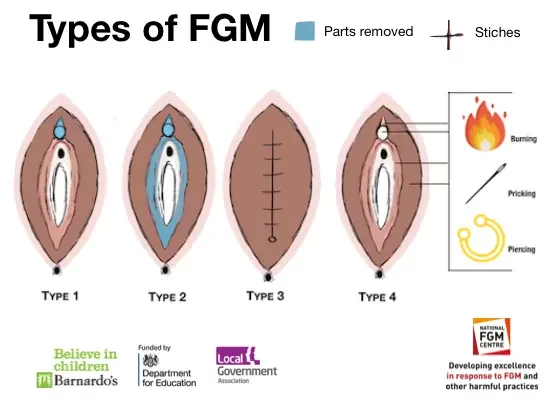 The horrors of female genital mutilation and infibulation