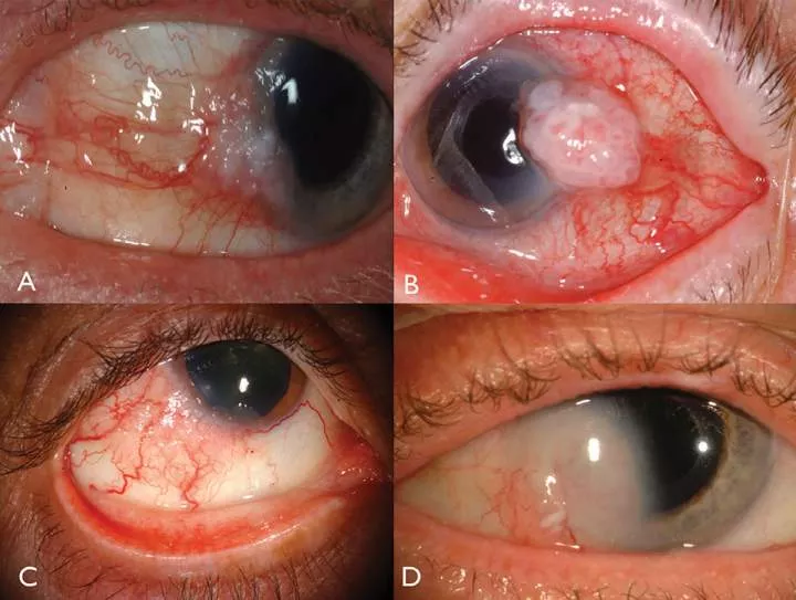 Crying blood and 5 other strange things that can happen to your eyes