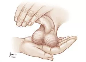 How much do you know about testicular cancer