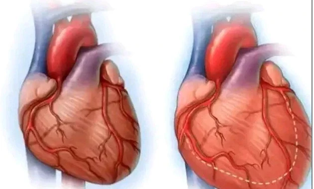 Heart Disease Kills Fast: Avoid Too Much Intake of These 4 Things If You Want to Live Lon