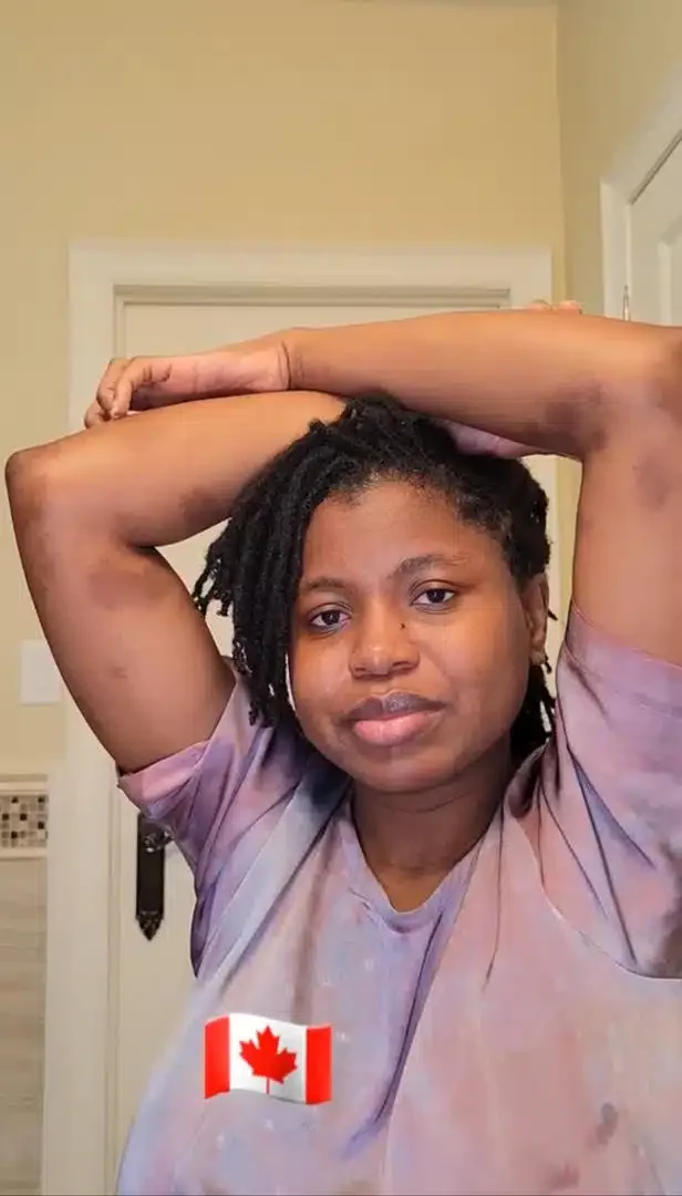 Nigerian lady who hoped for glowing skin battles allergy after relocating to Canada (Video)