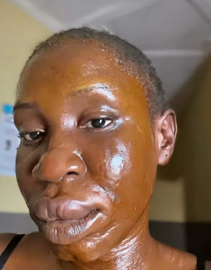 Lady shares the after effect of her allergic reaction to catfish