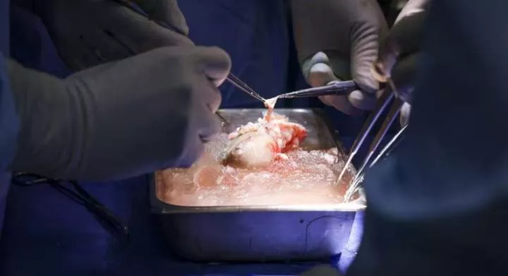 How doctors transferred pig's kidney into human patient for the first time