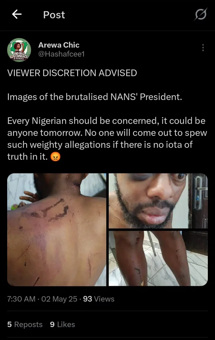Photos show injuries sustained by NANS president after alleged attack by Seyi Tinubu's thugs
