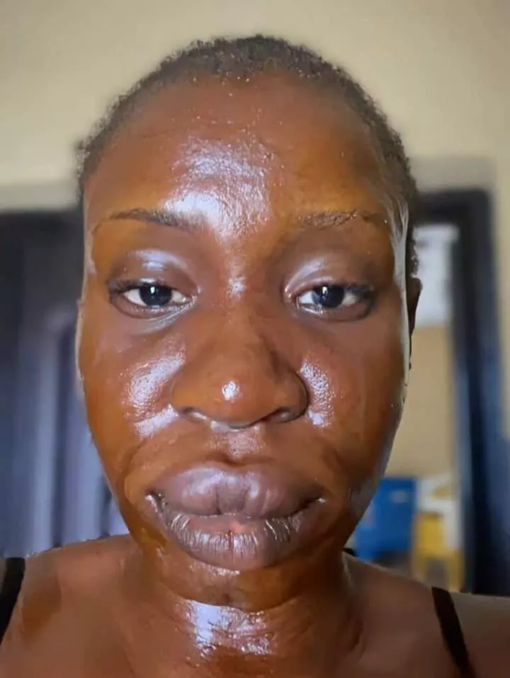 Lady shares the after effect of her allergic reaction to catfish