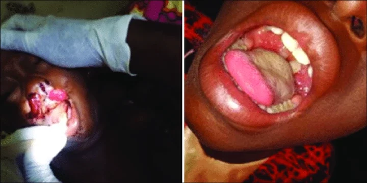 Diphtheria Outbreak: Deadly Disease That Has Claimed Over 400 Lives in Lagos, Abuja, and 15 States - Beware