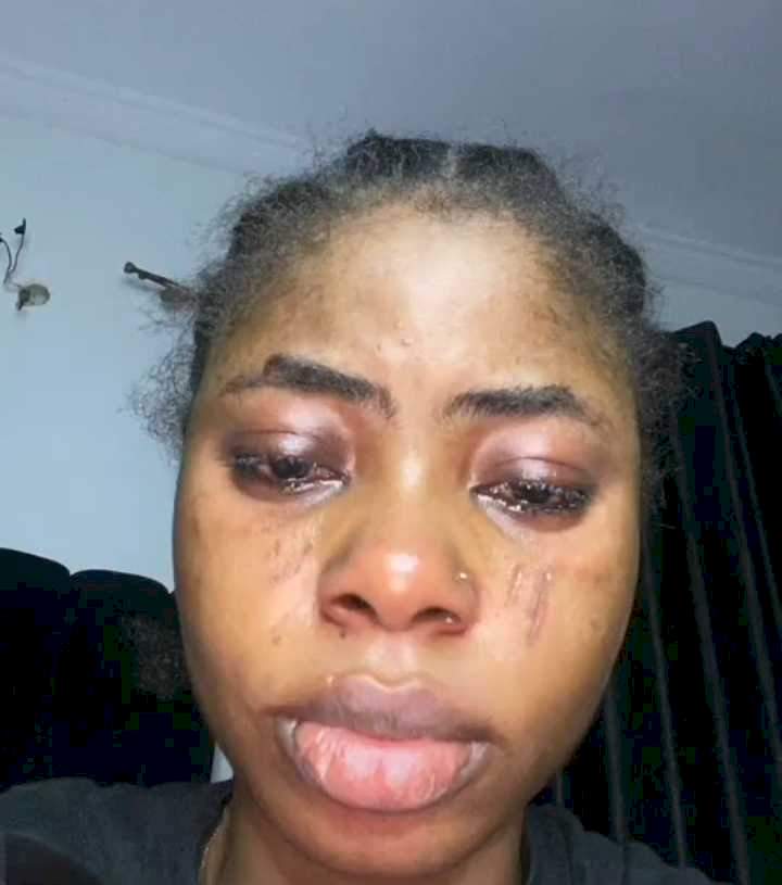 Lady cries out after laser procedure she underwent to remove tribal marks left her with additional marks (Video)