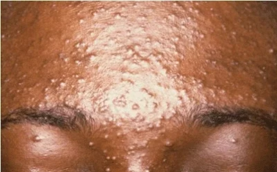 Say Goodbye to Pimples Forever by Following these 6 Simple Steps - Opinion