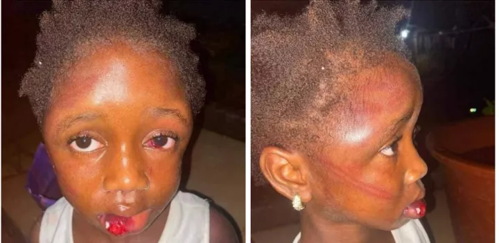 Starving 5-year-old girl mercilessly beaten by her aunt for taking food from pot to eat (Photos)