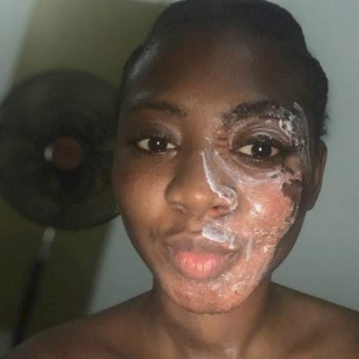 Woman shows impressive transformation 5 months after suffering burns (Photos)