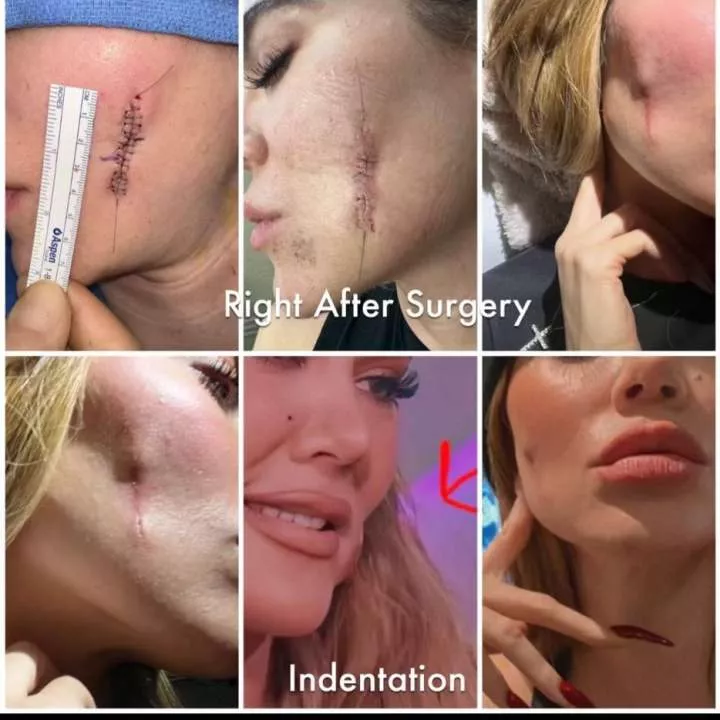 Khloe Kardashian shows scar on cheek as she gets candid about her skin cancer journey