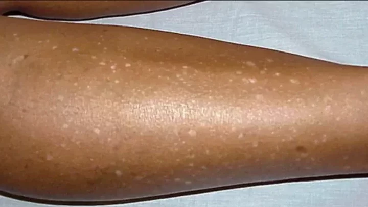 White Spots on Legs: What Causes Them and How to Get Rid of Them