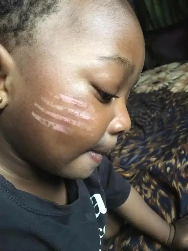 Mother angry as daycare teacher gives child four long marks on cheeks