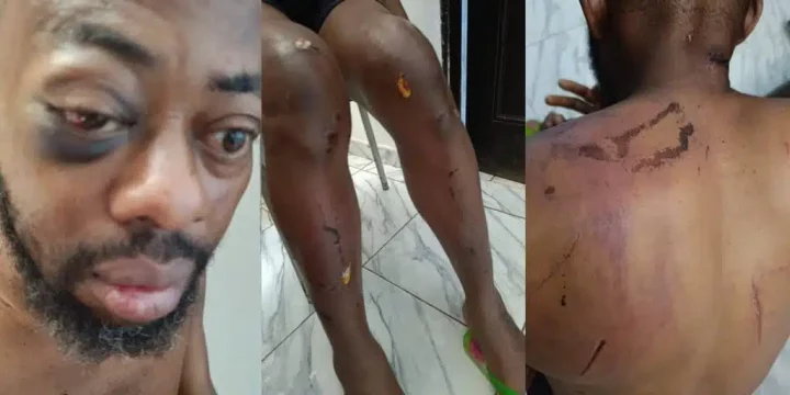 Photos show injuries sustained by NANS president after alleged attack by Seyi Tinubu's thugs Photos show injuries sustained by NANS president after alleged attack by Seyi Tinubu's thugs