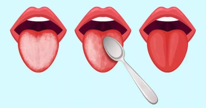 White Tongue: Symptoms, Causes, and Home Remedies for Treatment