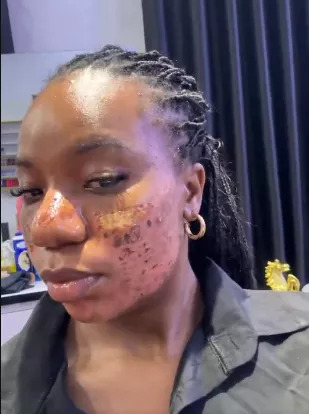 Lady accuses aesthetic clinic of permanent scar following skincare treatment